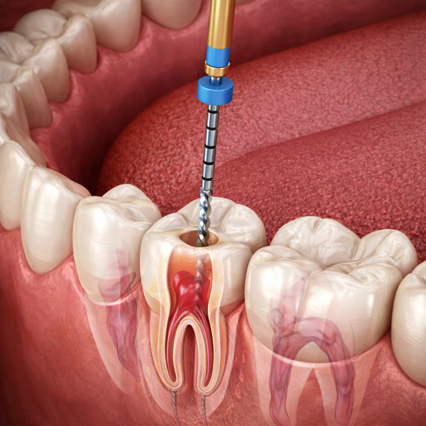 Root Canal Treatment in Lucknow